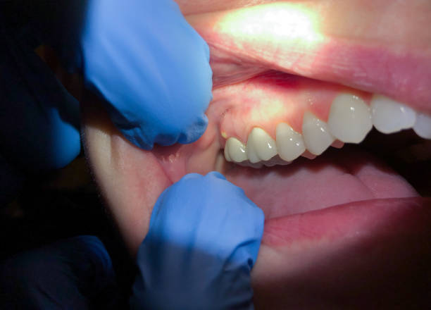 Best Emergency Treatment for Dental Infections or Abscesses in Opp, AL